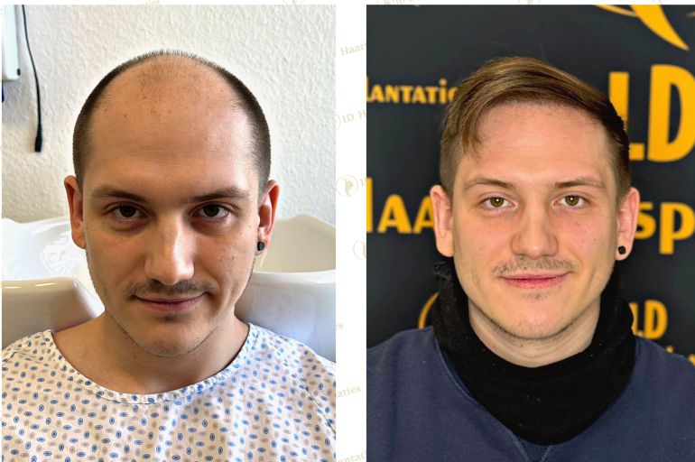 Haartransplantation Berlin