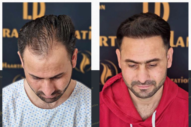 Haartransplantation Berlin