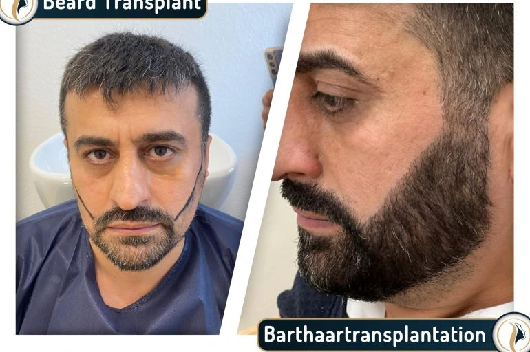 Mannheim Barttransplantation 