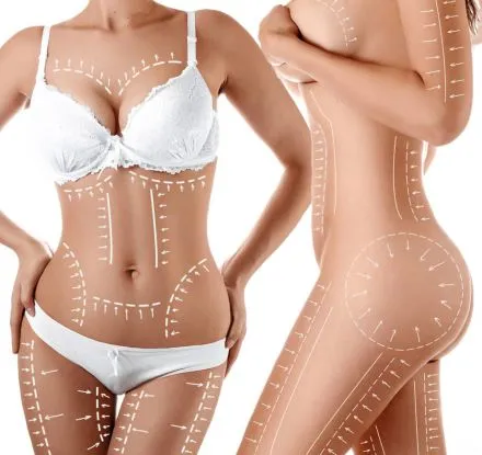 Liposuction