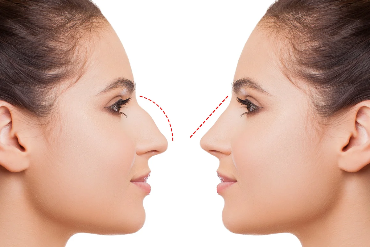 Rhinoplasty