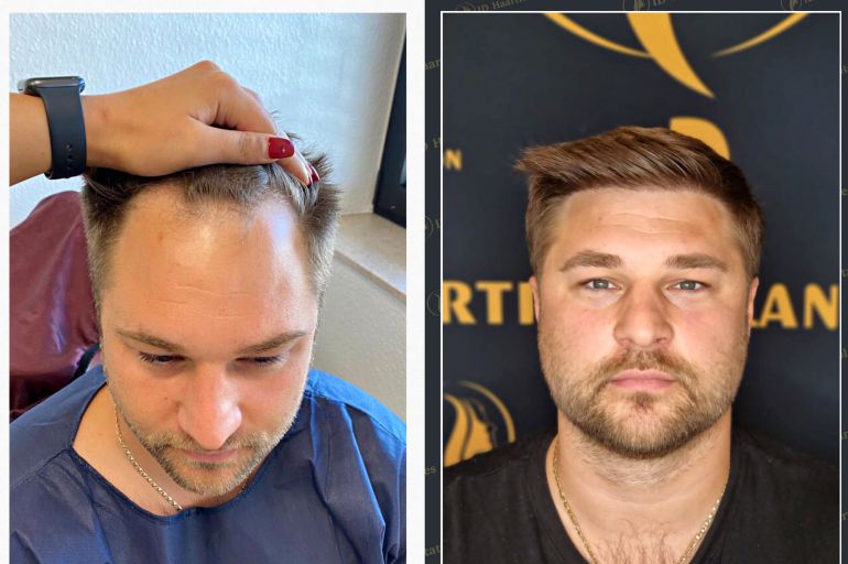 Haartransplantation in der Türkei