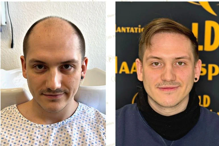 Beste Haartransplantationsklinik in Deutschland